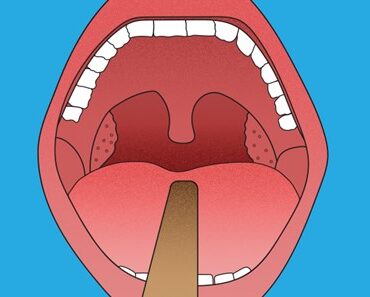 What Are The Disadvantages Of Removing Tonsils