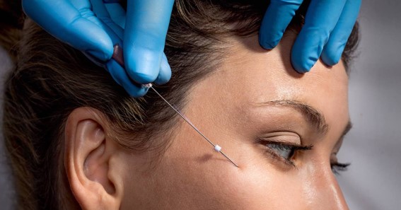 What Are The Disadvantages Of Thread Lift?